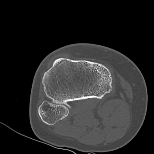 File:Anterior cruciate ligament avulsion fracture (Radiopaedia 58939-66194 Axial bone window 28).jpg