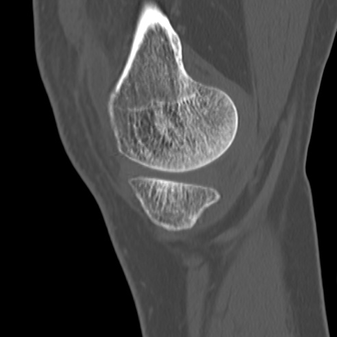 File:Anterior cruciate ligament avulsion fracture (Radiopaedia 58939-66194 Sagittal bone window 33).jpg