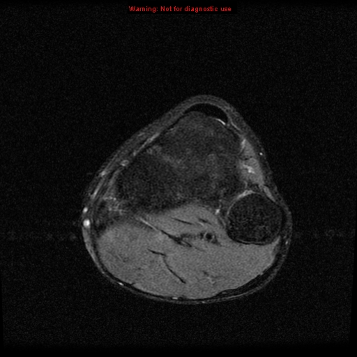 File:Anterior cruciate ligament injury - partial thickness tear (Radiopaedia 12176-12515 Axial PD 22).jpg