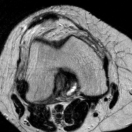 File:Anterior cruciate ligament mucoid degeneration (Radiopaedia 60853-68633 Axial T2 17).jpg