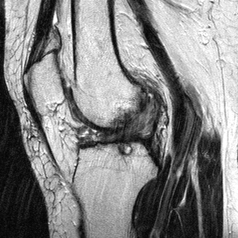 File:Anterior cruciate ligament mucoid degeneration (Radiopaedia 60853-68633 Sagittal T2 16).jpg