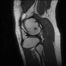 Anterior cruciate ligament rupture and posteromedial corner injury (Radiopaedia 67338-76723 Sagittal PD 137).jpg