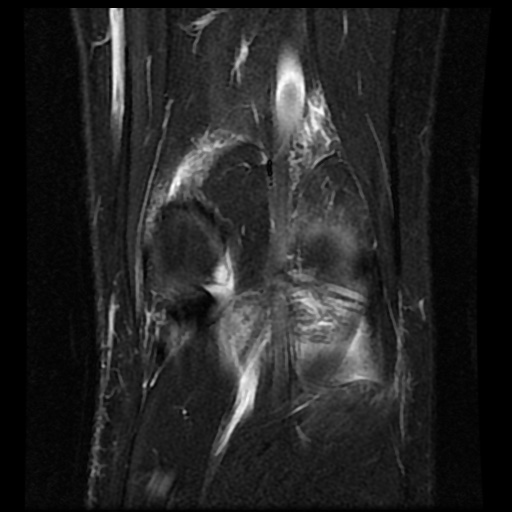 File:Anterior cruciate ligament tear (Radiopaedia 61500-69462 Coronal STIR 18).jpg