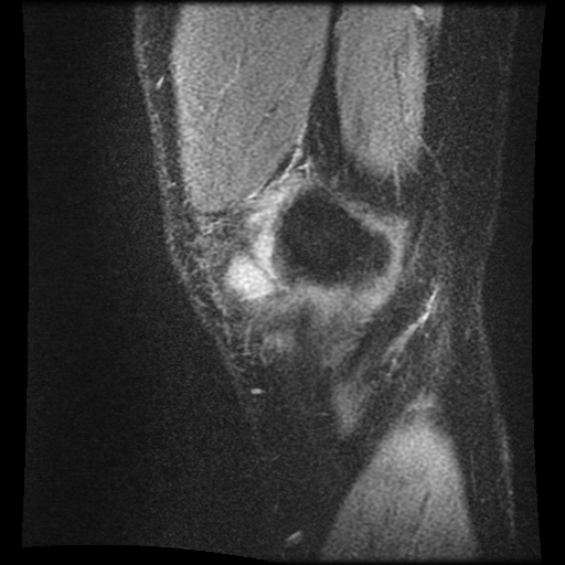File:Anterior cruciate ligament tear (Radiopaedia 61500-69462 F 1).jpg