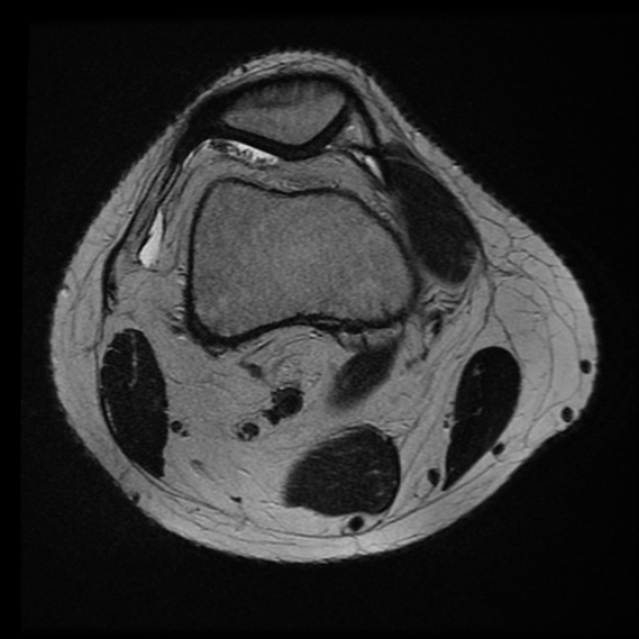 File:Anterior cruciate ligament tear with posteromedial corner injury, bucket-handle meniscal tear and chondral delamination (Radiopaedia 75501-86744 Axial T2 22).jpg