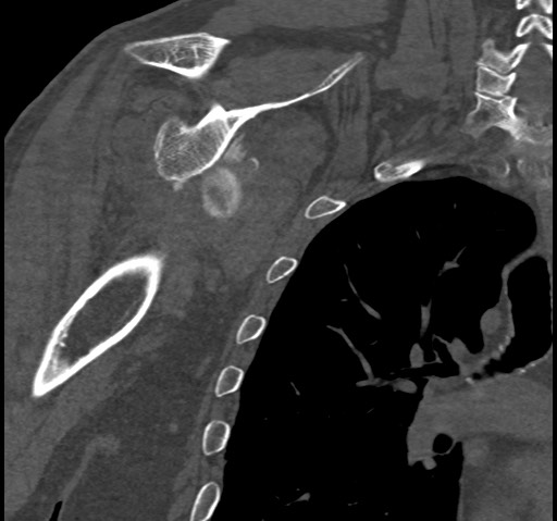 File:Anterior glenohumeral dislocation with Hill-Sachs lesion (Radiopaedia 62877-71249 Coronal bone window 62).jpg