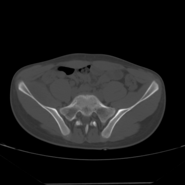 Anterior inferior iliac spine avulsion fracture (Radiopaedia 49469-54627 Axial bone window 9).jpg