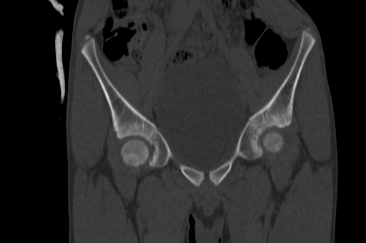 Anterior inferior iliac spine avulsion injury (Radiopaedia 88666-105376 Coronal bone window 26).jpg