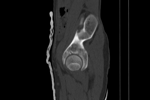 Anterior inferior iliac spine avulsion injury (Radiopaedia 88666-105376 Sagittal bone window 31).jpg