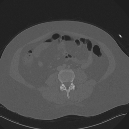 Anterior superior iliac spine avulsion fracture (Radiopaedia 44541-48244 Axial bone window 58).png