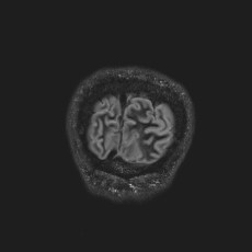 Anterior temporal encephalocele (Radiopaedia 82624-96808 Coronal FLAIR 52).jpg