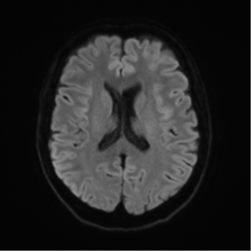 File:Anterior temporal lobe perivascular space (Radiopaedia 40946-43650 Axial DWI 43).png