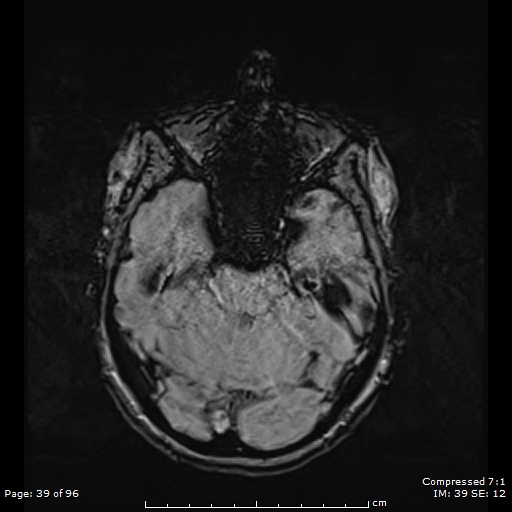 Anterior temporal lobe perivascular space (Radiopaedia 88283-104914 Axial SWI 8).jpg