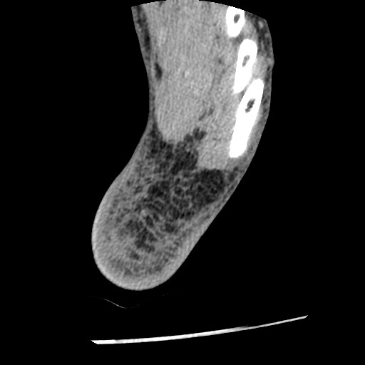 Anterior tibial artery false aneurysm (Radiopaedia 88984-105809 A 244).jpg