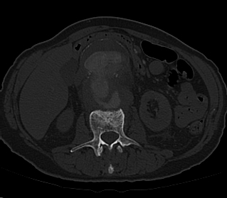 File:Anterior vertebral scalloping (abdominal aortic aneurysm) (Radiopaedia 66744-76067 Axial bone window 6).jpg