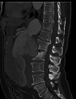 File:Anterior vertebral scalloping (abdominal aortic aneurysm) (Radiopaedia 66744-76067 Sagittal bone window 38).jpg