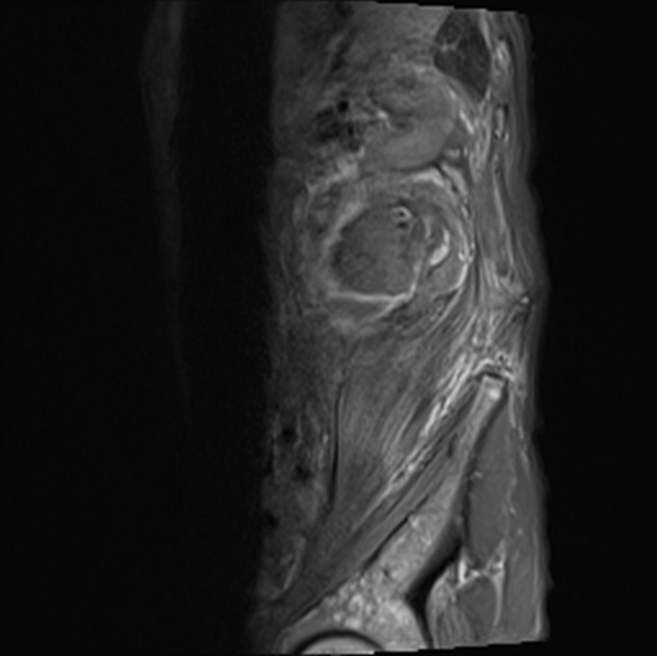 File:Aortic aneurysm with spinal destruction (Radiopaedia 42301-45409 Sagittal T1 fat sat 40).jpg