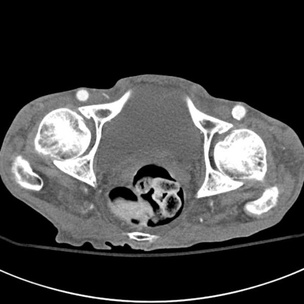File:Aortic aneurysm with spinal destruction (Radiopaedia 42301-45410 A 107).jpg