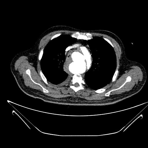 Aortic arch aneurysm (Radiopaedia 84109-99365 B 191).jpg