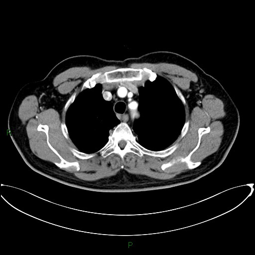 Aortic arch origin of left vertebral artery (Radiopaedia 46327-50737 Axial post contrast 27).jpg