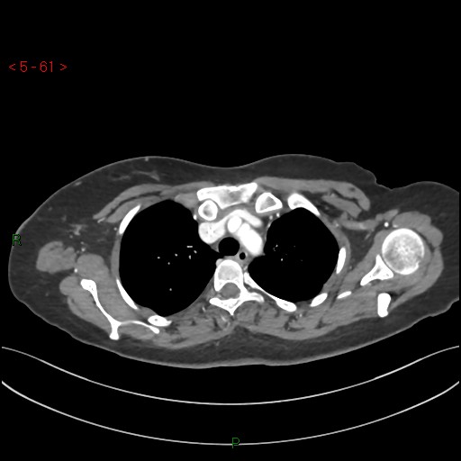 Aortic arch origin of left vertebral artery (Radiopaedia 51520-57286 A 60).jpg