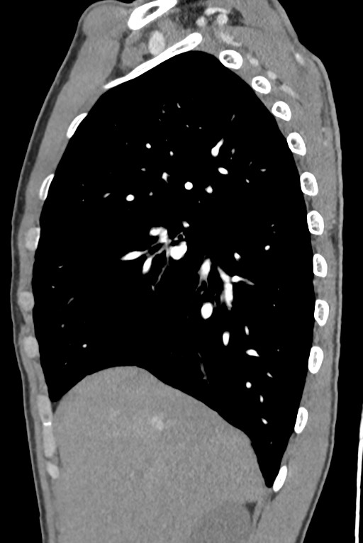 Aortic coarctation with aneurysm (Radiopaedia 74818-85828 B 48).jpg