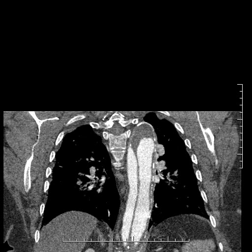 Aortic dissection- Stanford A (Radiopaedia 35729-37268 E 8).jpg