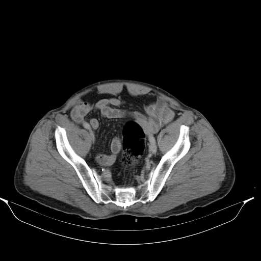 File:Aortic dissection- Stanford type A (Radiopaedia 22085-22085 Axial C+ delayed 44).jpg
