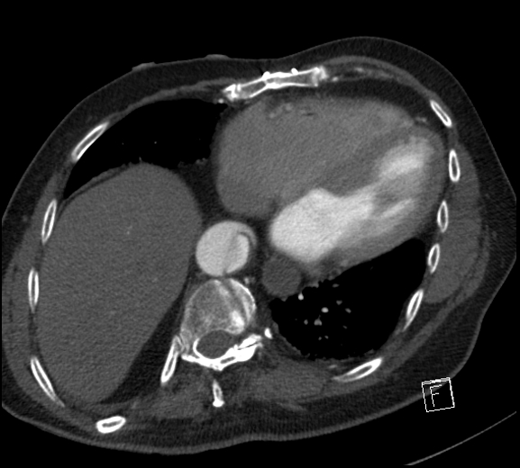 File:Aortic dissection (CTPA) (Radiopaedia 75506-86750 A 68).jpg