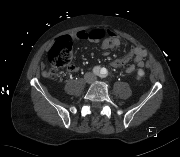 Aortic dissection (CTPA) (Radiopaedia 75506-86750 E 99).jpg