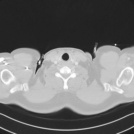 File:Aortic dissection (Radiopaedia 50763-56234 Axial lung window 3).png