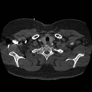 File:Aortic dissection (Radiopaedia 57969-64959 A 28).jpg