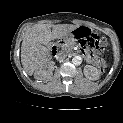File:Aortic dissection - Stanford A -DeBakey I (Radiopaedia 28339-28587 B 123).jpg