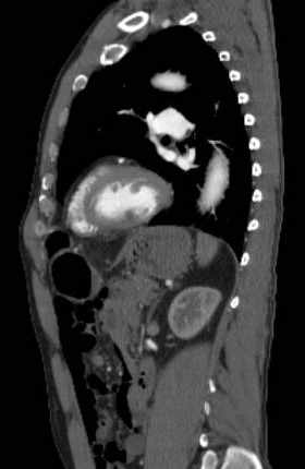File:Aortic dissection - Stanford type B (Radiopaedia 73648-84437 C 53).jpg