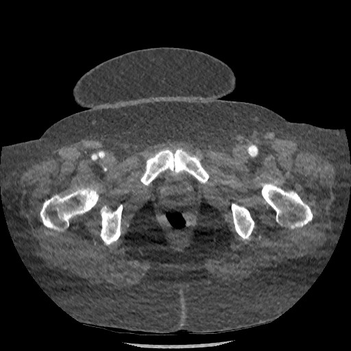 Aortic dissection - Stanford type B (Radiopaedia 88281-104910 A 162).jpg