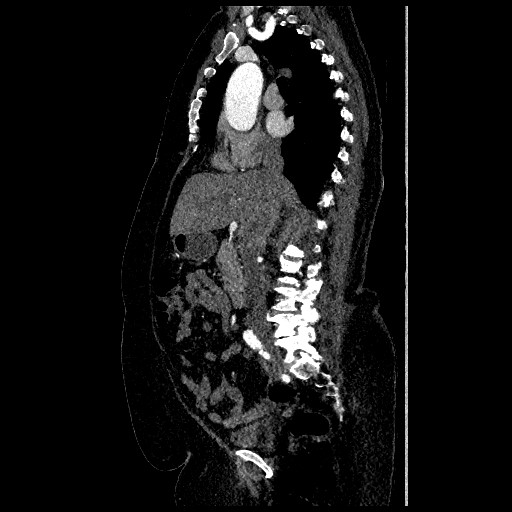 File:Aortic dissection - Stanford type B (Radiopaedia 88281-104910 C 32).jpg