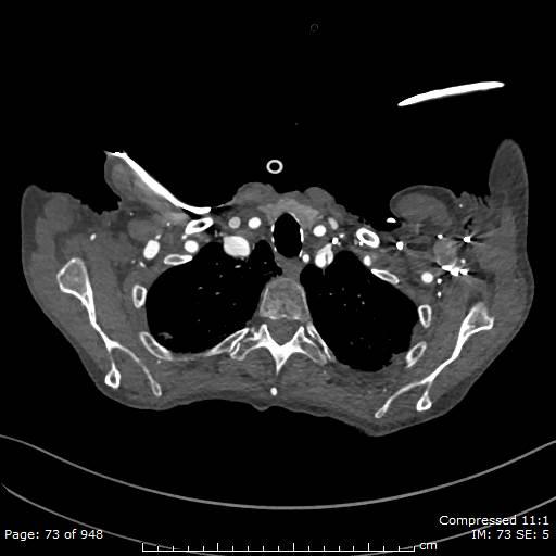 Aortic dissection with extension into aortic arch branches (Radiopaedia 64402-73204 B 73).jpg