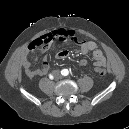 Aortic intramural hematoma (Radiopaedia 31139-31838 B 124).jpg