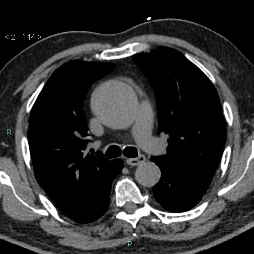 Aortic intramural hematoma (Radiopaedia 48463-53380 Axial non-contrast 64).jpg