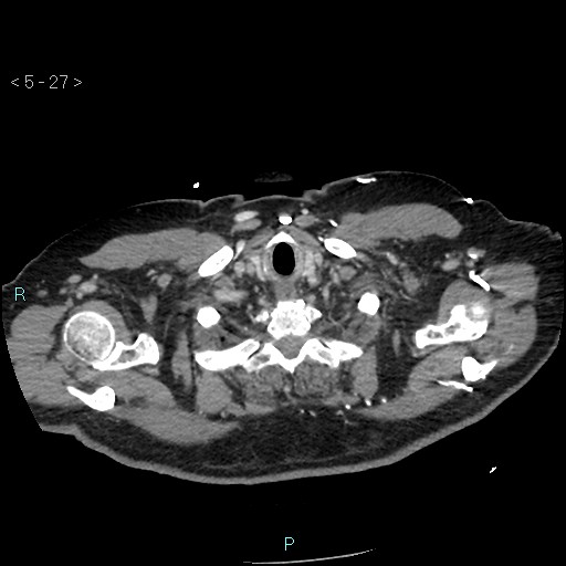 Aortic intramural hematoma (Radiopaedia 48463-53380 C 13).jpg