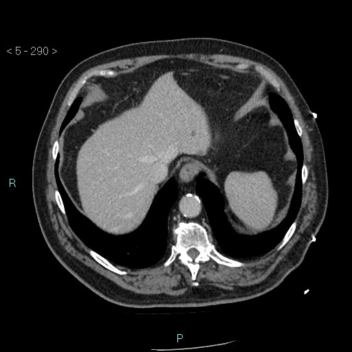 Aortic intramural hematoma (Radiopaedia 48463-53380 C 130).jpg