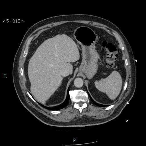 Aortic intramural hematoma (Radiopaedia 48463-53380 C 141).jpg