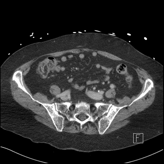 Aortic intramural hematoma with dissection and intramural blood pool (Radiopaedia 77373-89491 E 71).jpg