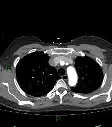 Aortic valve endocarditis (Radiopaedia 87209-103485 C 23).jpg