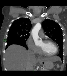 Aortic valve endocarditis (Radiopaedia 87209-103485 D 43).jpg