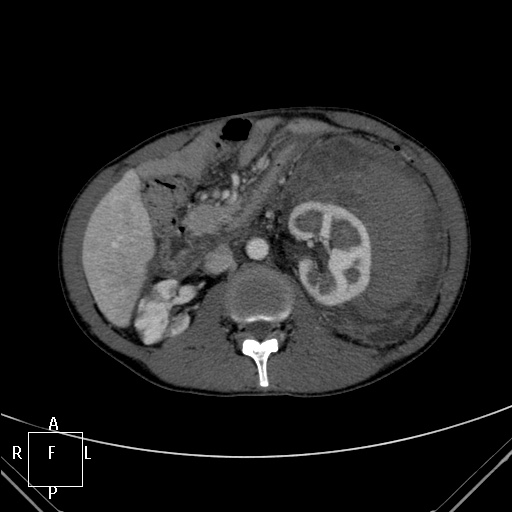 File:Aorto-left renal vein fistula (Radiopaedia 45534-49628 A 26).jpg