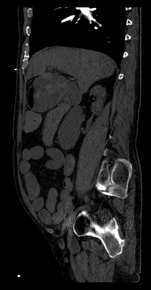 Aortoduodenal fistula (Radiopaedia 75286-86415 F 45).jpg