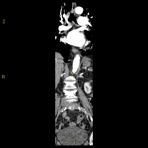 File:Aortoiliac occlusive disease (Radiopaedia 16828-16548 B 41).jpg