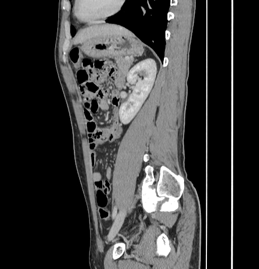 Appendiceal mucinous adenocarcinoma (Radiopaedia 66605-75922 C 46).jpg