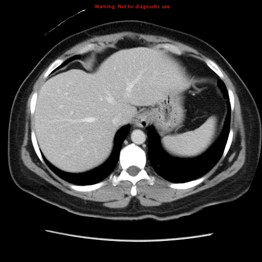 Appendiceal mucinous cystadenoma (Radiopaedia 8263-9111 Axial liver window 17).jpg